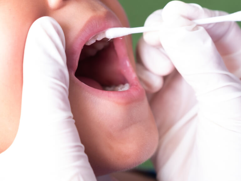 Fluoride Treatment