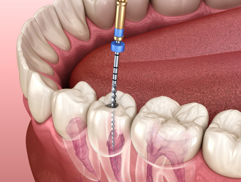 Root Canal Therapy