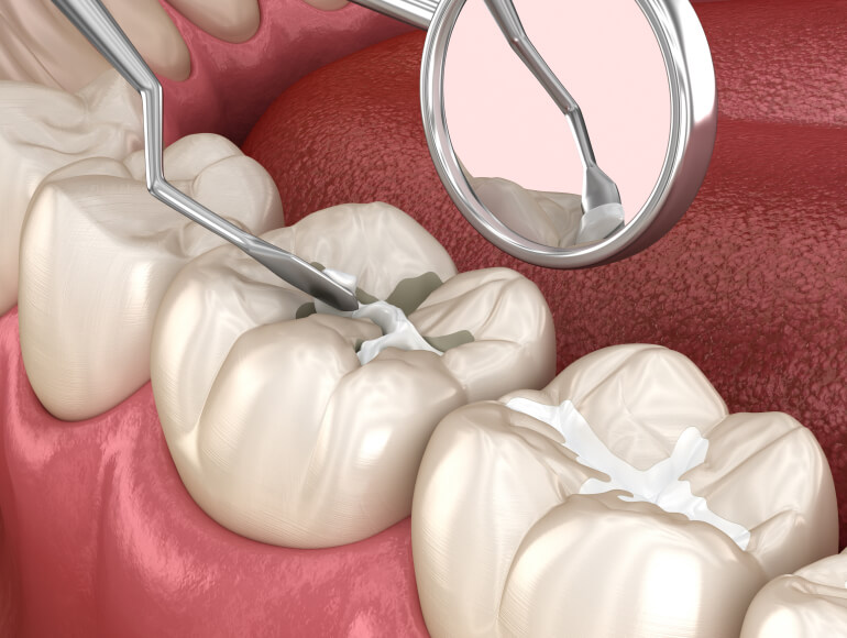 Dental Sealants