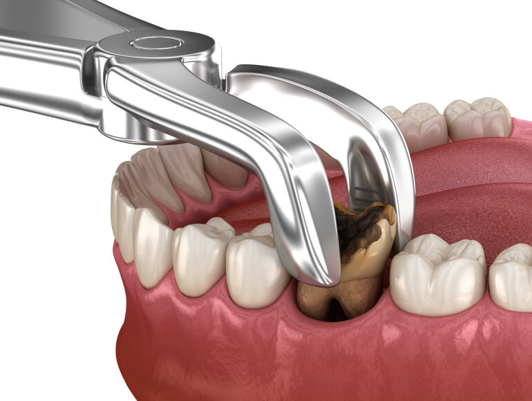 Tooth Extractions