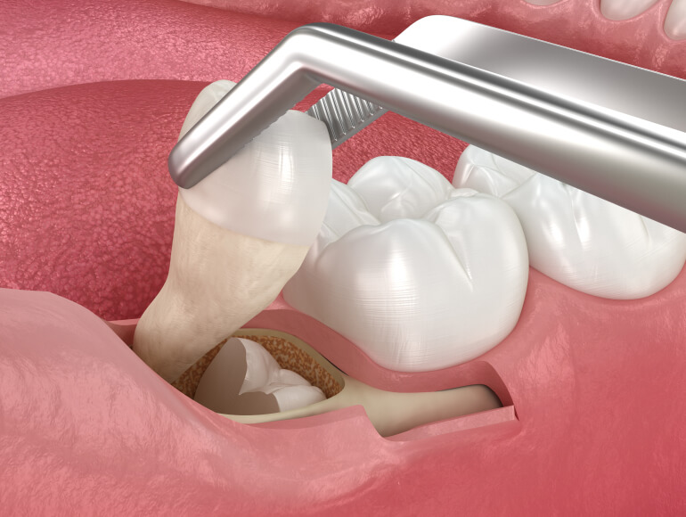 Wisdom Teeth