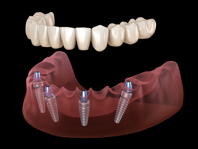 All-on-4 dental implants in Tuscaloosa, AL