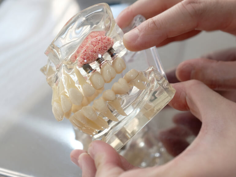 Bone grafting in Manteca, CA — Valley View Dental