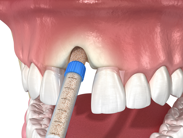 Bone grafting for dental implants in Tuscaloosa, AL