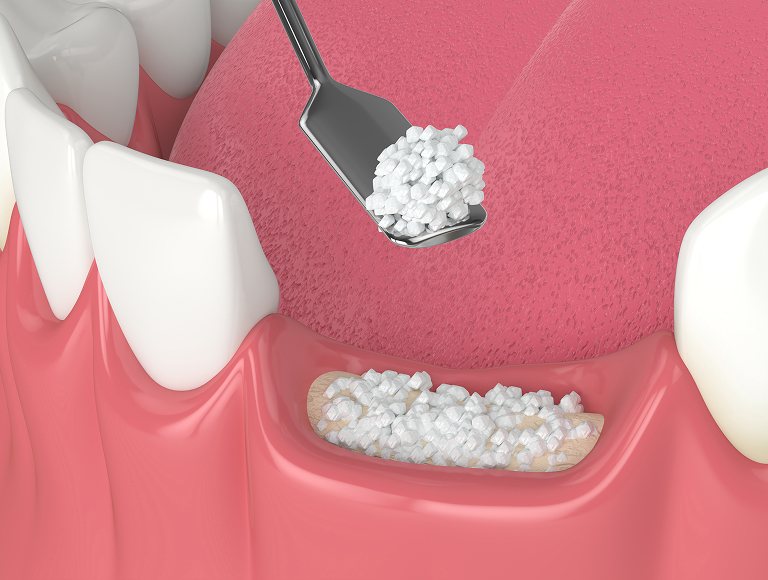 Types of bone grafting procedures