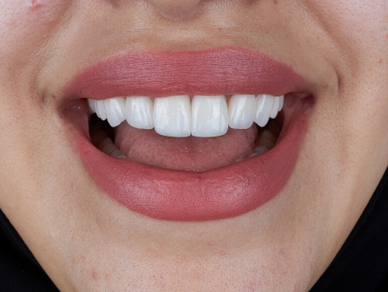 Is dental bonding right for you? — Valley View Dental Manteca