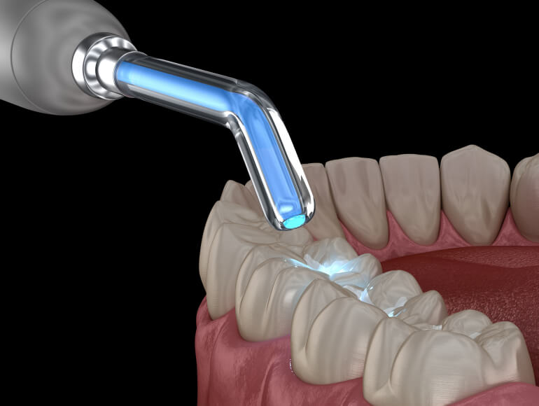 Dental fillings in Manteca, CA — Valley View Dental