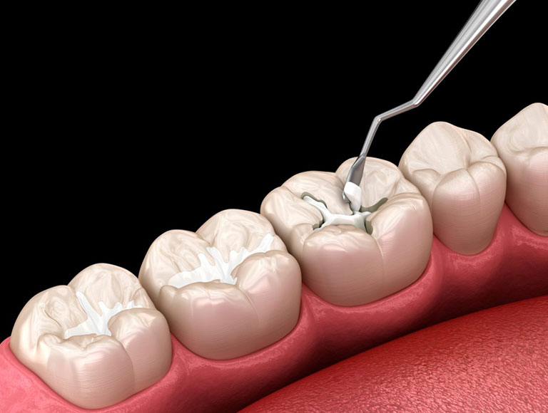 Wondering if dental sealants are right for you? — Valley View Dental Manteca