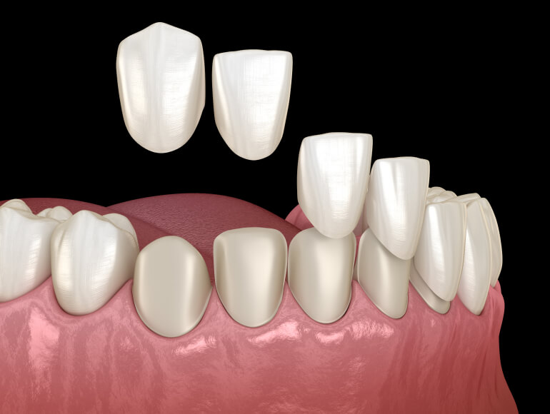 Transform Your Smile with Dental Veneers in Manteca CA — Valley View Dental