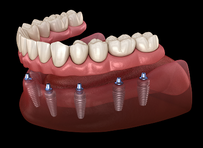 Custom Dentures
