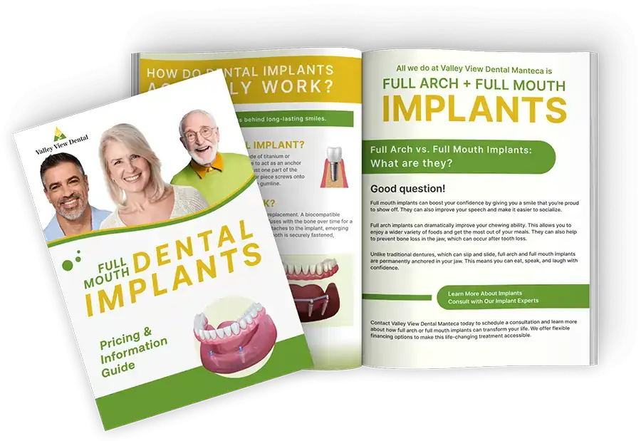 Dental Implant Guide