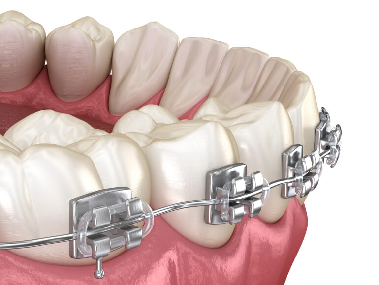 Who Can Benefit from Metal Braces? — Valley View Dental Manteca CA