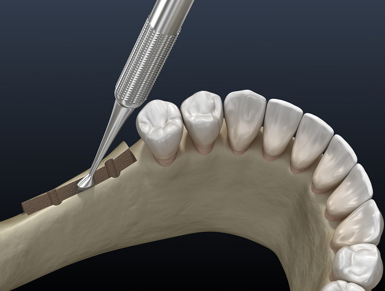 Ridge augmentation in Tuscaloosa, AL