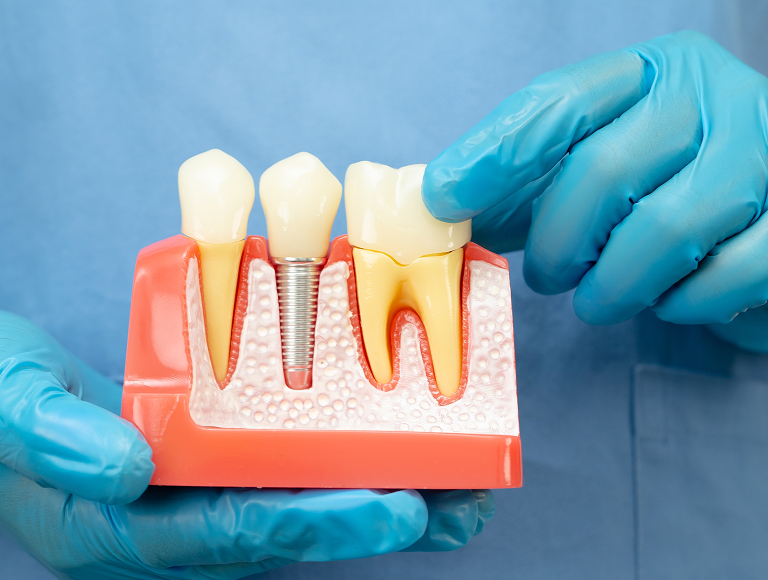 Same day dental implants in Tuscaloosa, AL