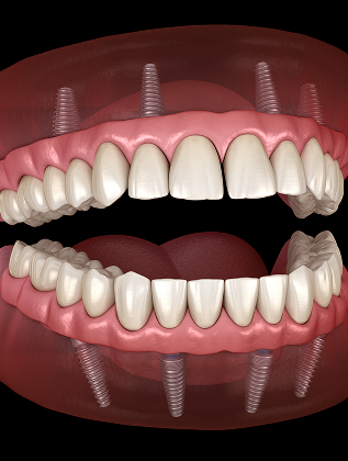 Implant Supported Dentures