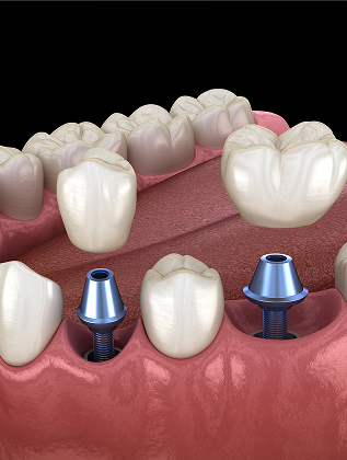 Same Day Dental Implants