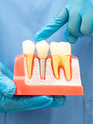 Single Tooth Implants