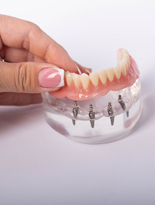 Failed Implant Replacement