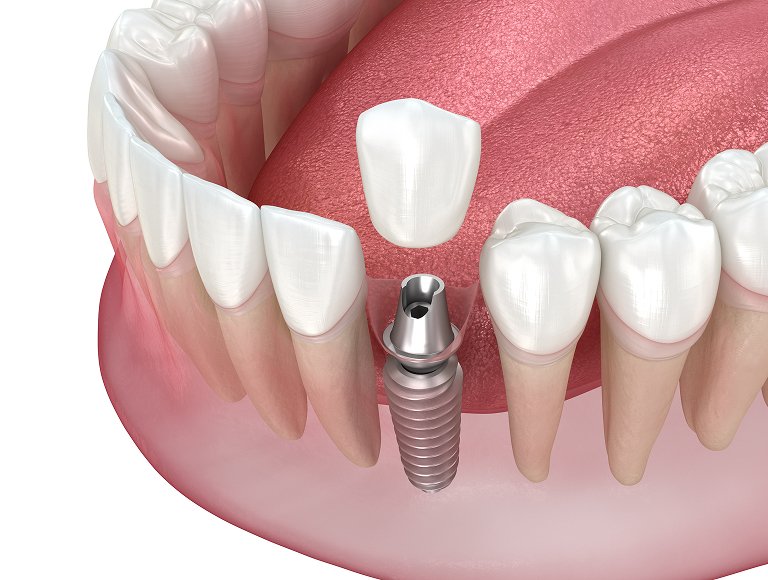 Single tooth implants in Tuscaloosa, AL
