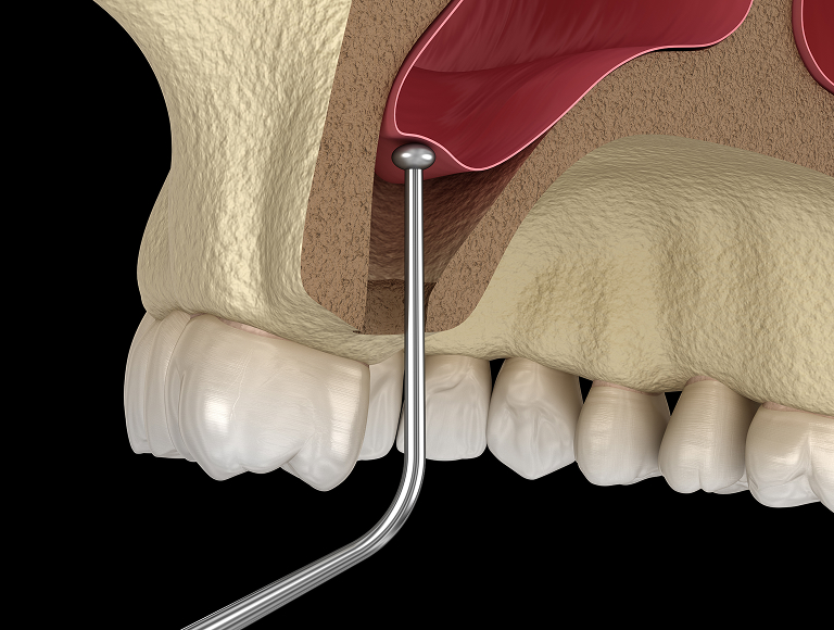 Sinus lift surgery in Tuscaloosa, AL