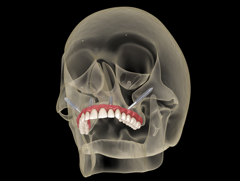 Sinus lift vs zygomatic implants comparison